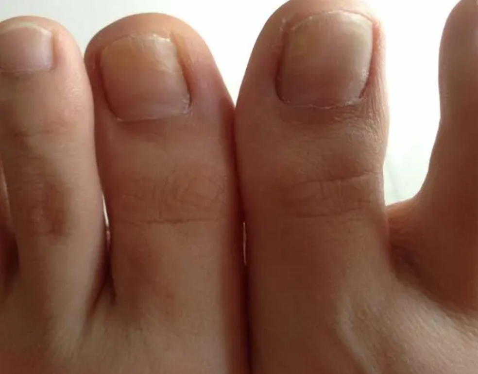 脚大拇指关节痛看什么科 什么原因已经怎么治疗和预防方法